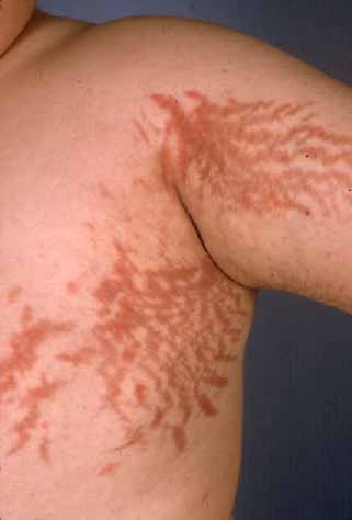 Sindrome di Cushing, parere europeo positivo del Comitato EMA per osilodrostat dell'italiana Recordati