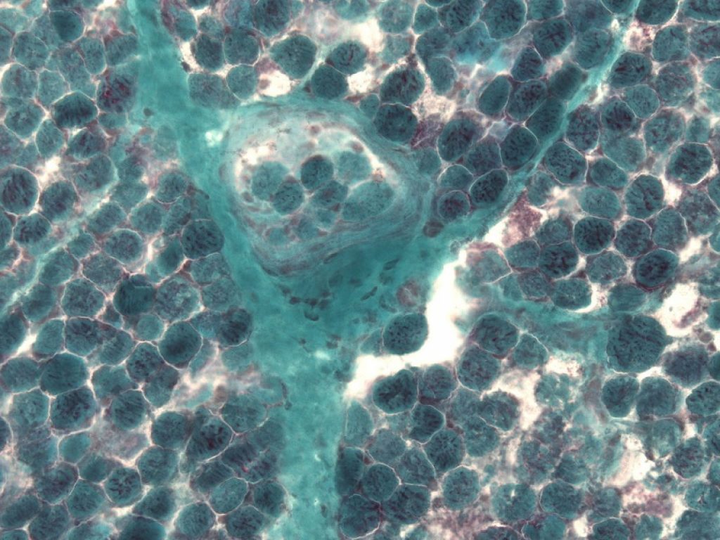 Sindrome di Leigh, aperto il primo bando del “Leigh Syndrome Roadmap Project”: l'obiettivo è promuovere la ricerca di potenziali terapie