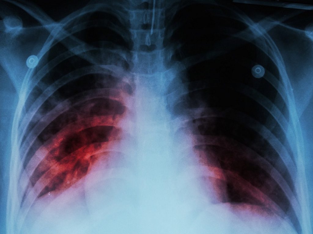 Tubercolosi: secondo un nuovo studio la mortalità per tutte le cause sembra essere maggiore nel sesso maschile rispetto al sesso femminile