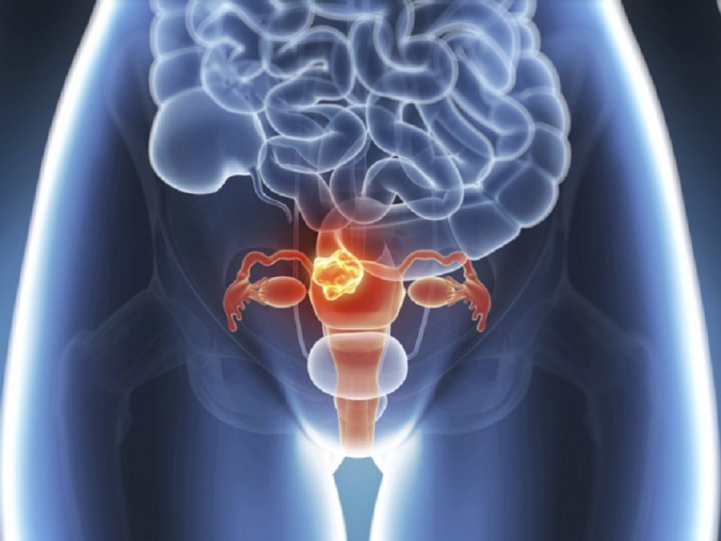 Nelle pazienti con tumore della cervice uterina PD-L1-positivo, ricorrente o metastatico, l'aggiunta di anlotinib a sintilimab si è dimostrata efficace