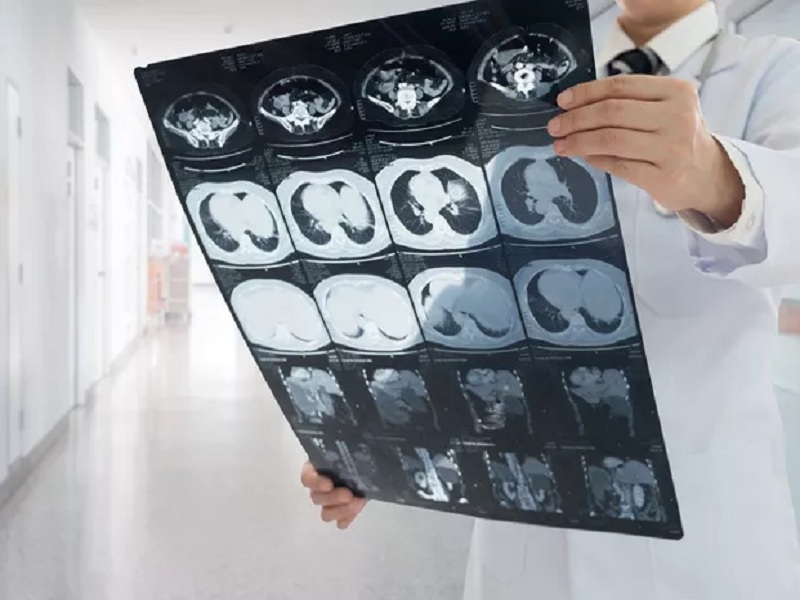 Colangiocarcinoma: la Commissione Europea ha concesso l'autorizzazione condizionata all'immissione in commercio della monoterapia a base di futibatinib