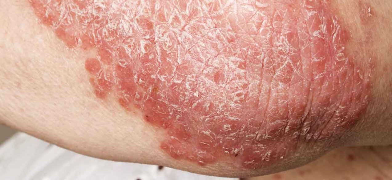 Nei pazienti con epidermolisi bollosa distrofica, rara malattia genetica della pelle, una nuova terapia genica topica sperimentale ha guarito la maggior parte delle lesioni