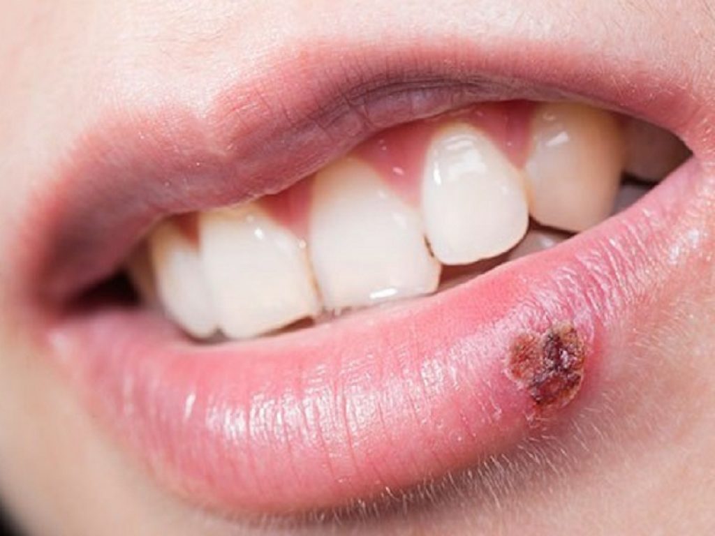 Herpes Labialis: l'infezione che lo causa si ripresenta nel tempo perché resta "ospite" del nostro organismo. Attenzione ai sintomi che ne preannunciano il ritorno