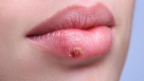Herpes Labiale: l'infezione che lo causa si ripresenta nel tempo perché resta "ospite" del nostro organismo. Attenzione ai sintomi che ne preannunciano il ritorno