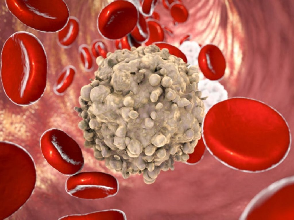 Leucemia mieloide acuta: magrolimab mostra risposte cliniche durature in pazienti non trattati in precedenza