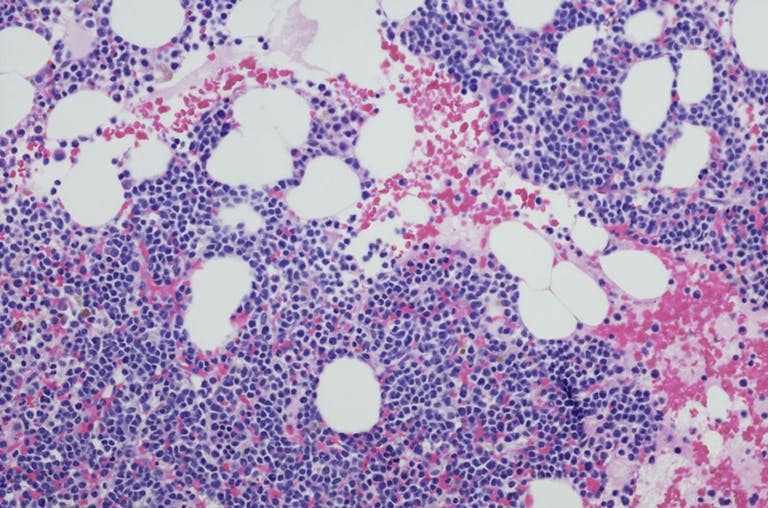 Mieloma multiplo: il trattamento con il nuovo anticorpo bispecifico linvoseltamab è in grado di produrre alti tassi di risposta, con risposte rapide e durature