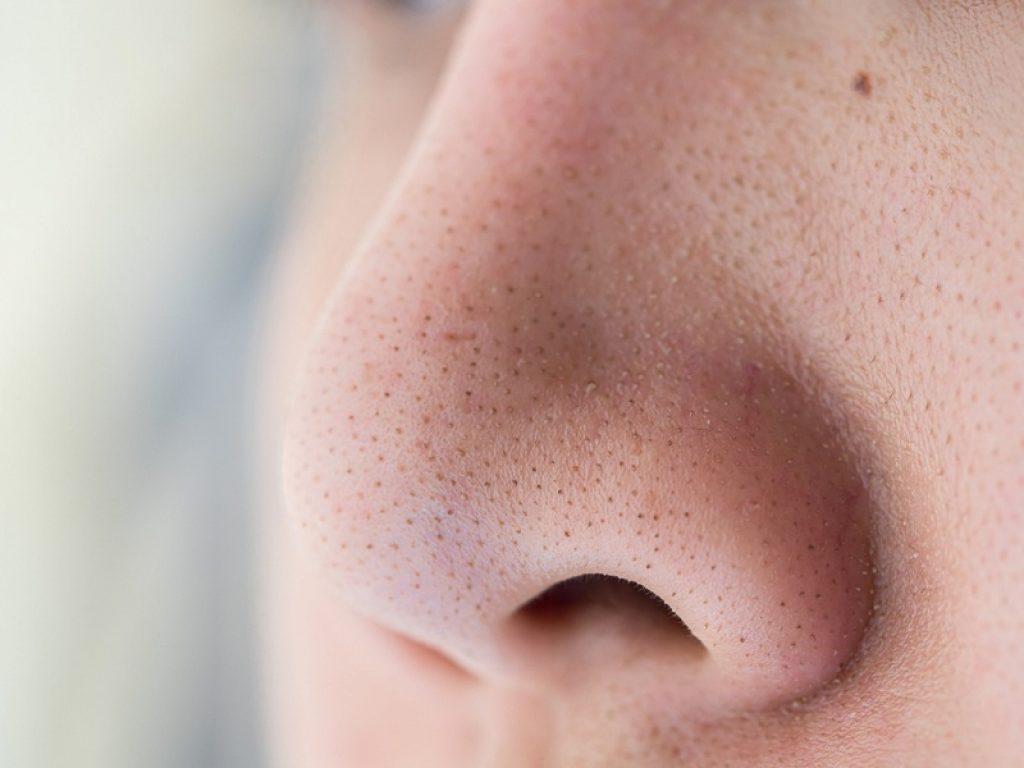 La poliposi nasale è una malattia cronica recidivante: nella maggior parte dei casi si tratta di tumori benigni, ecco sintomi, diagnosi e cura