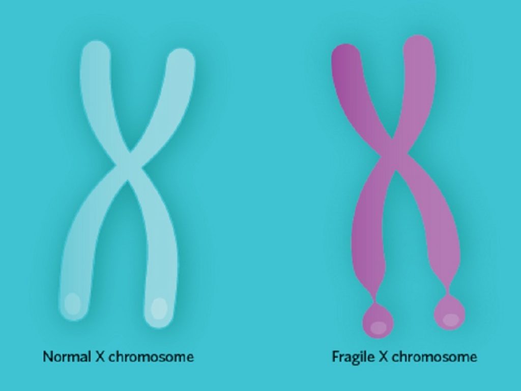 Sindrome dell'X fragile causata dall'alterazione di un gene sul cromosoma X: le cure prevedono interventi abilitativi età dipendenti