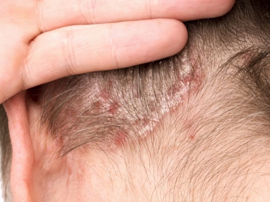 Dalla dermatite seborroica difficilmente si può guarire, ma occorre imparare a conviverci