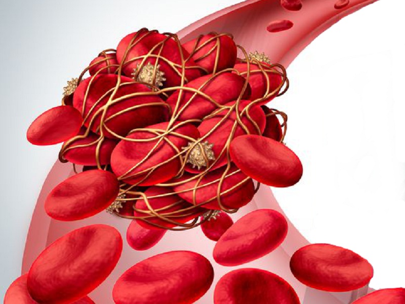 Rivaroxaban a bassa dose riduce il rischio i pazienti COVID-19 ospedalizzati con un alto rischio di tromboembolia venosa