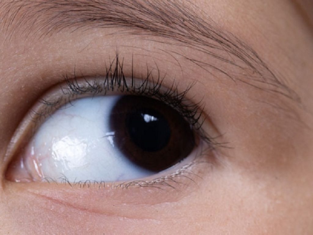 Aniridia, una malattia rara che ha nei geni la causa scatenante: può provocare l’insorgenza di altre patologie oculari e disturbi che possono portare a ipovisione