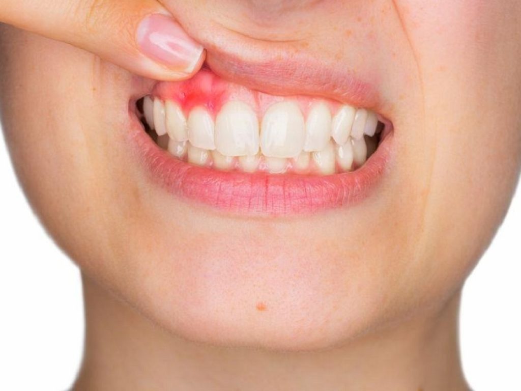 Studio ha osservato negli adolescenti affetti da artrite idiopatica giovanile un incremento della gengivite, indipendentemente dall'igiene orale