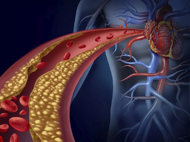 Ipercolesterolemia familiare omozigote, alirocumab efficace: colesterolo-LDL ridotto del 36% secondo lo studio clinico di fase 3 ODYSSEY