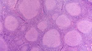 Linfoma follicolare recidivato/refrattario:  mosunetuzumab migliora il tasso di risposta secondo un nuovo studio