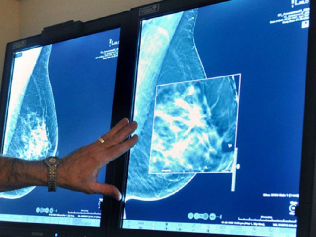 Tumore al seno metastatico, abemaciclib rimborsato in Italia. Si usa in associazione con un NSAI e senza la chemioterapia