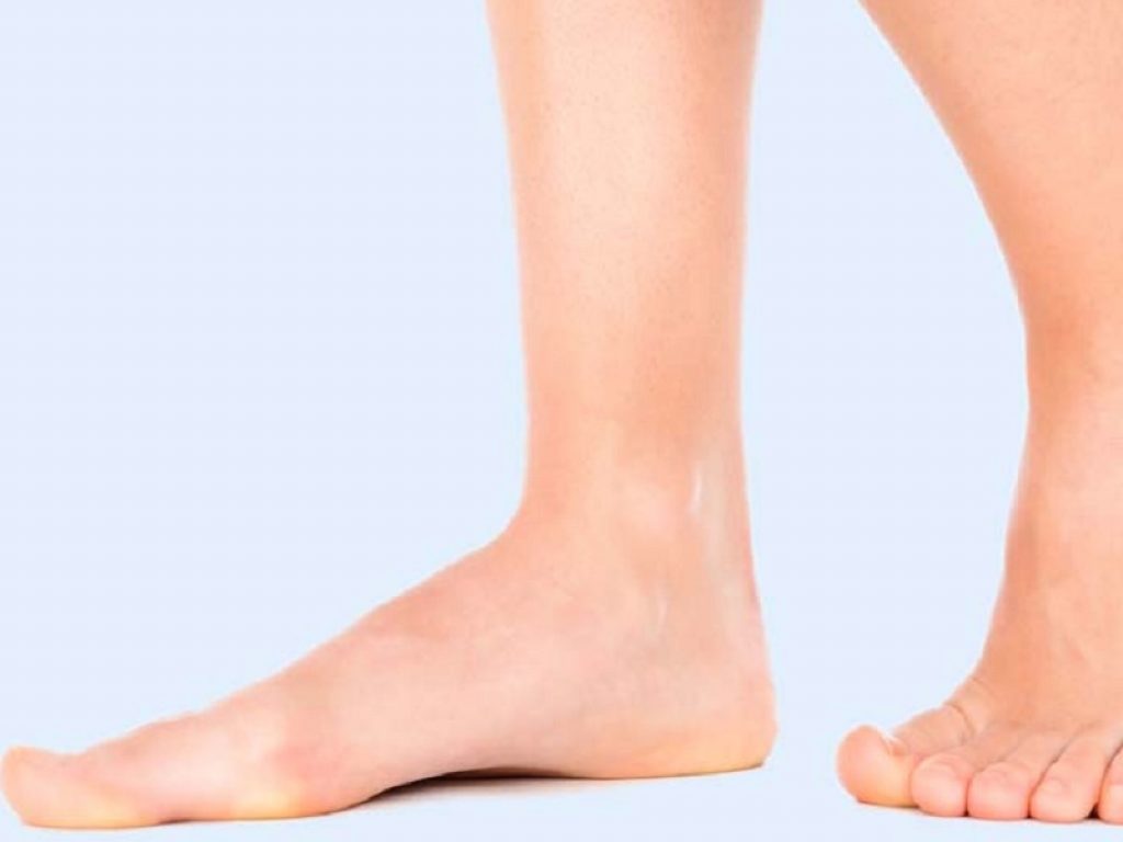 Il piede piatto è una patologia che può avere conseguenze anche in età adulta: accade nel 30% dei casi in cui la malattia giovanile non è stata trattata