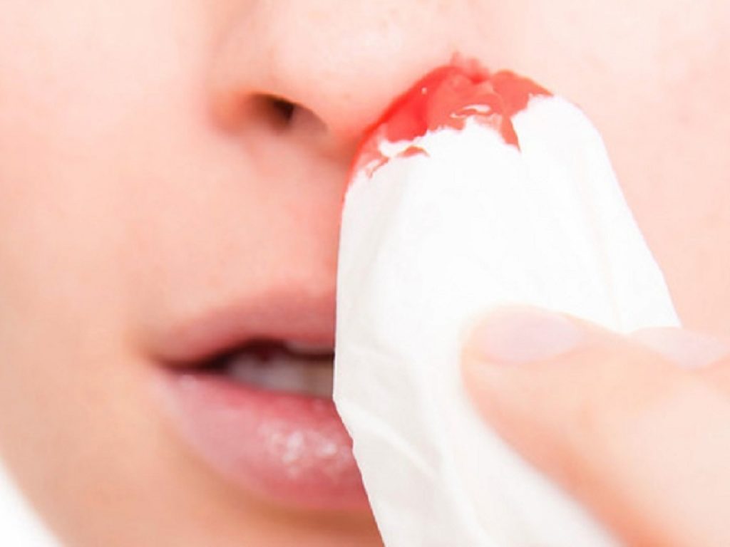 La perdita di sangue dal naso o epistassi, nella maggior parte dei casi, non è qualcosa di preoccupante: ecco cosa fare con i bambini