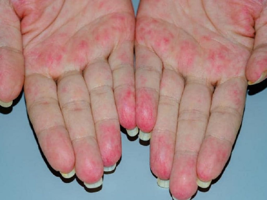 Vasculite ANCA-associata: avacopan superiore allo standard di terapia e può migliorare i tassi di remissione sostenuta