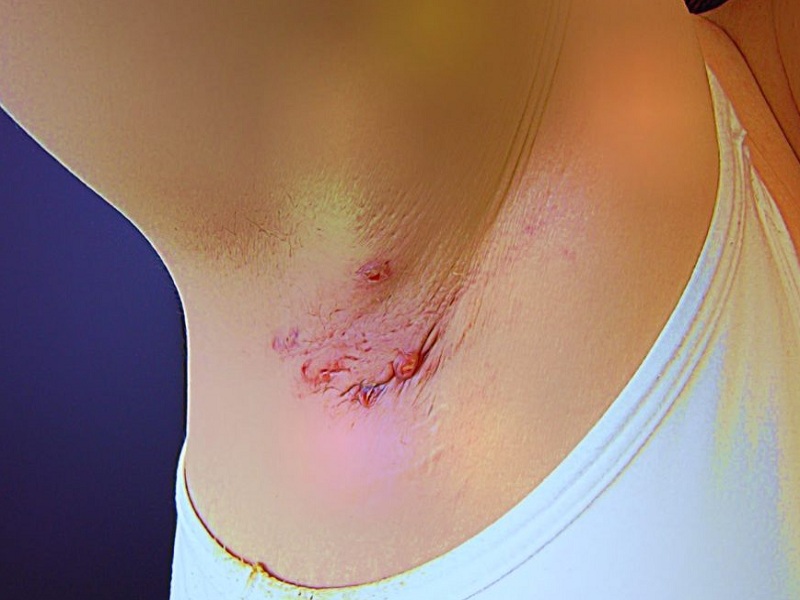 I pazienti con idrosadenite suppurativa, una malattia dermatologica che può portare a enormi sofferenze fisiche e psicologiche, hanno un maggior rischio di sviluppare una artrite infiammatoria