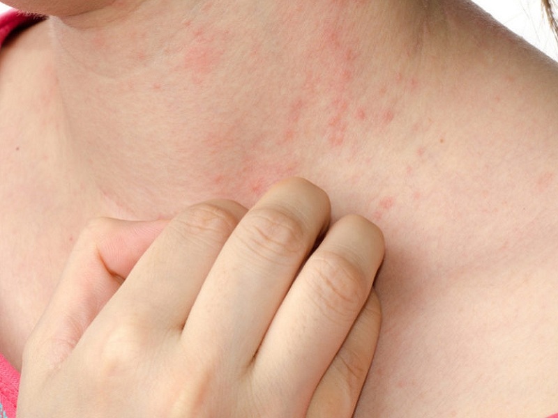 Prurigo nodularis, nuove speranze per i pazienti: risultati promettenti per la terapia con l'anticorpo monoclonale nemolizumab