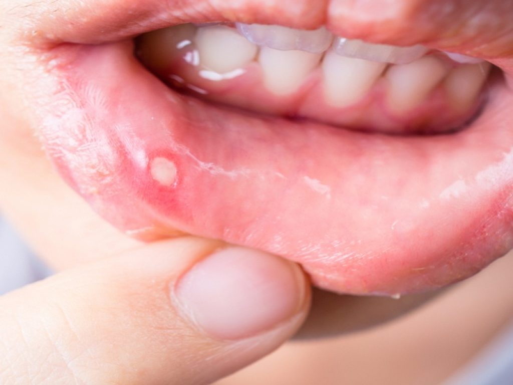 Malattia di Behçet: nuova indicazione per apremilast, l'inibitore della PDE4, dopo il parere positivo del Chmp dell'Agenzia Europea del Farmaco.