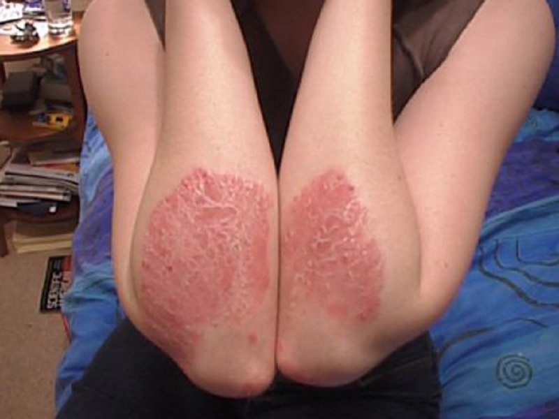 Psoriasi a placche: la biotech Dermavant Sciences ha chiesto alla Fda l'approvazione di tapinarof in crema per il trattamento degli adulti