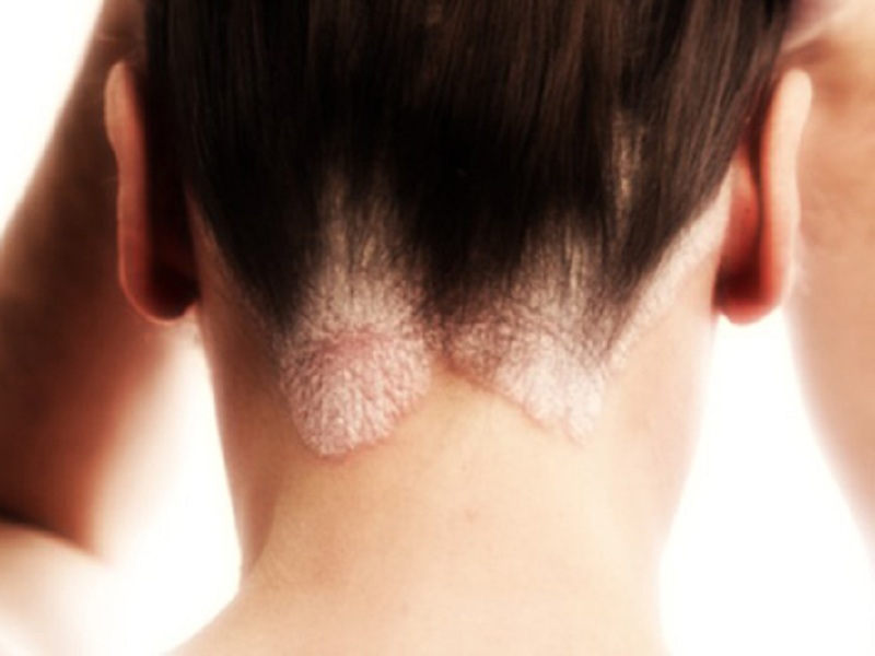 Psoriasi pediatrica, la terapia sistemica non aumenta il rischio di infezioni gravi secondo uno studio pubblicato sul Journal of the American Academy of Dermatology