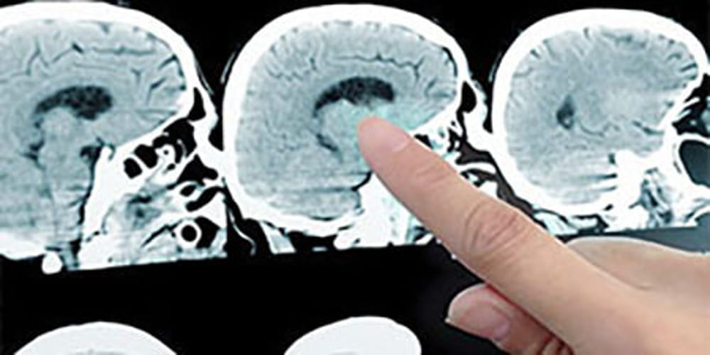 Sclerosi multipla: da uno studio svedese nuove conferme di efficacia per il trapianto autologo di staminali ematopoietiche