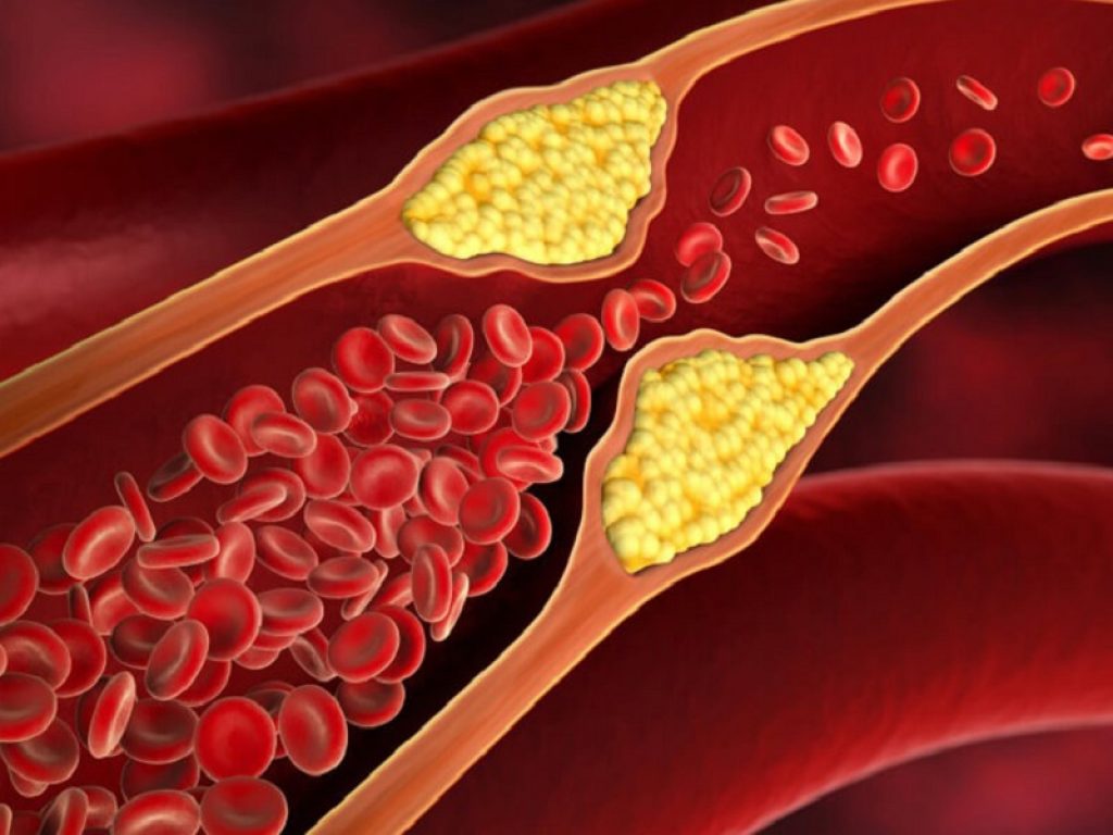 Le terapia estrogenica orale può ridurre la progressione dell'aterosclerosi a livello carotideo, a seconda però di quando si inizia