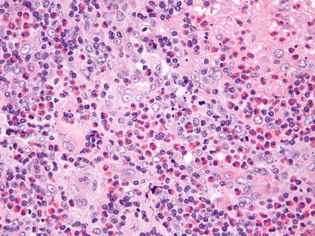 Benralizumab, utilizzato con successo nell'asma grave eosinofilico, è efficace e sicuro anche per la granulomatosi eosinofila con poliangioite