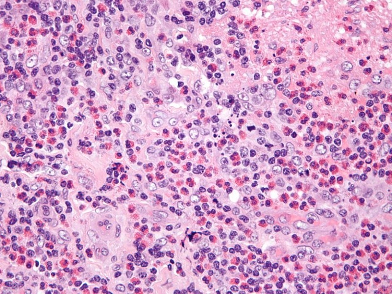 Benralizumab, utilizzato con successo nell'asma grave eosinofilico, è efficace e sicuro anche per la granulomatosi eosinofila con poliangioite