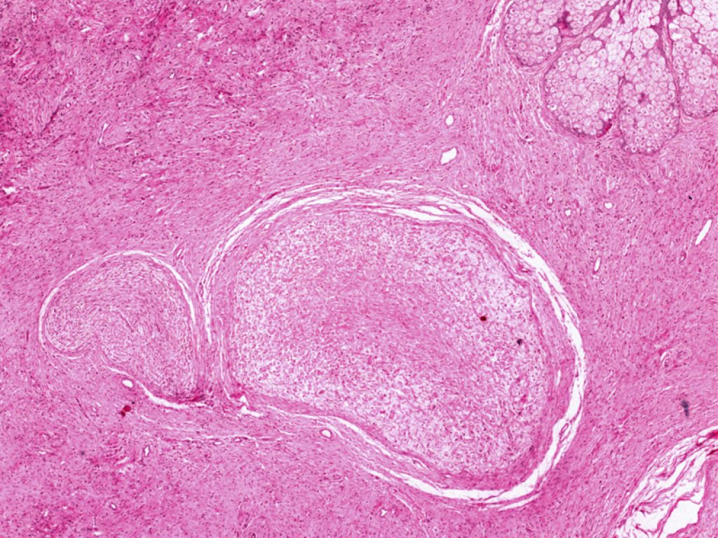 Più della metà dei bambini con neurofibromi plessiformi non operabili ha risposto bene all'inibitore di MEK selumetinib secondo un nuovo studio