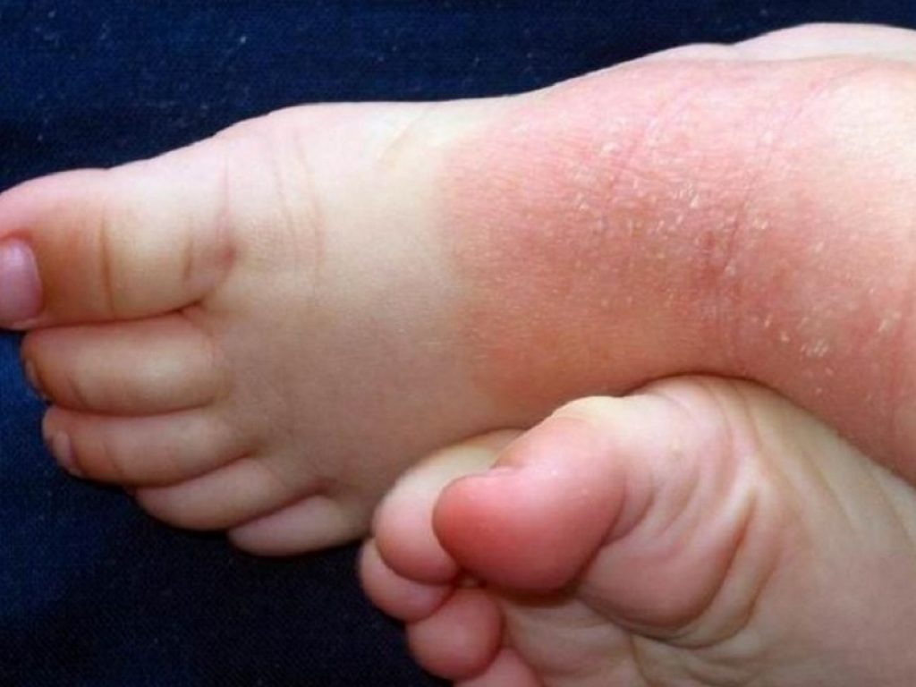 Dermatite atopica grave: l'UE estende la commercializzazione di dupilumab per includere i bambini da 6 a 11 anni 