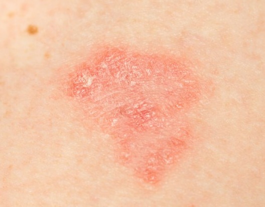 Dermatite atopica: upadacitinib più rapido ed efficace del farmaco biologico di riferimento nel ridurre le lesioni cutanee