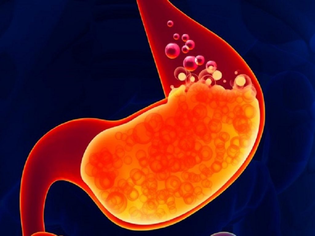 Gli inibitori di pompa protonica, classe di farmaci per il reflusso acido e i sintomi correlati, aumentano del 20% il rischio di fratture nei bambini