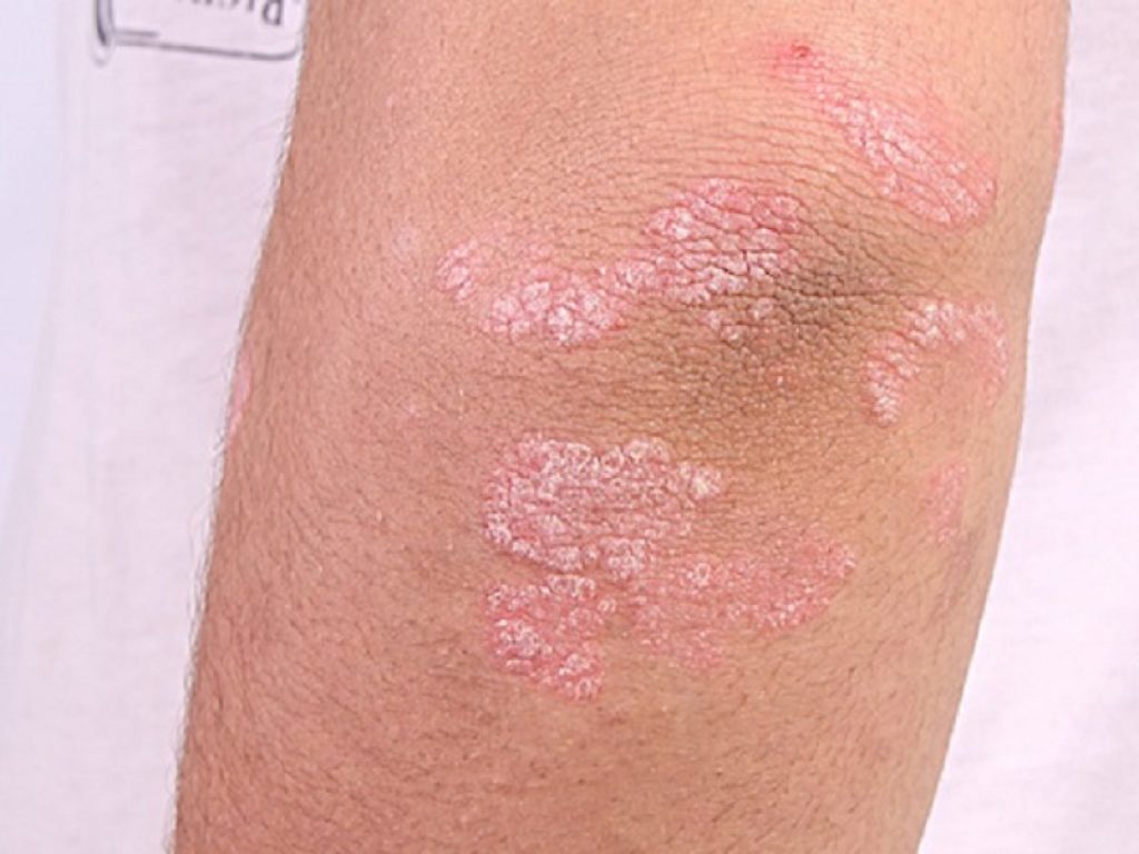 Nei pazienti pediatrici affetti da psoriasi da moderata a grave, i farmaci biologici sembrano avere maggiori probabilità di migliorare la malattia rispetto al metotrexato