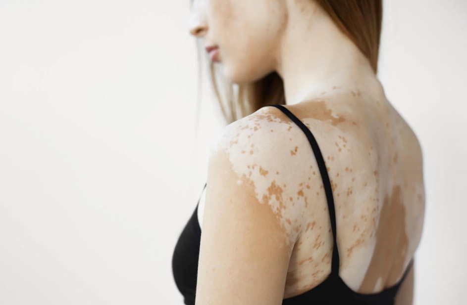 Vitiligine: con il JAK inibitore ruxolitinib in crema ripigmentazione facciale e corporea secondo i risultati di uno studio di fase II