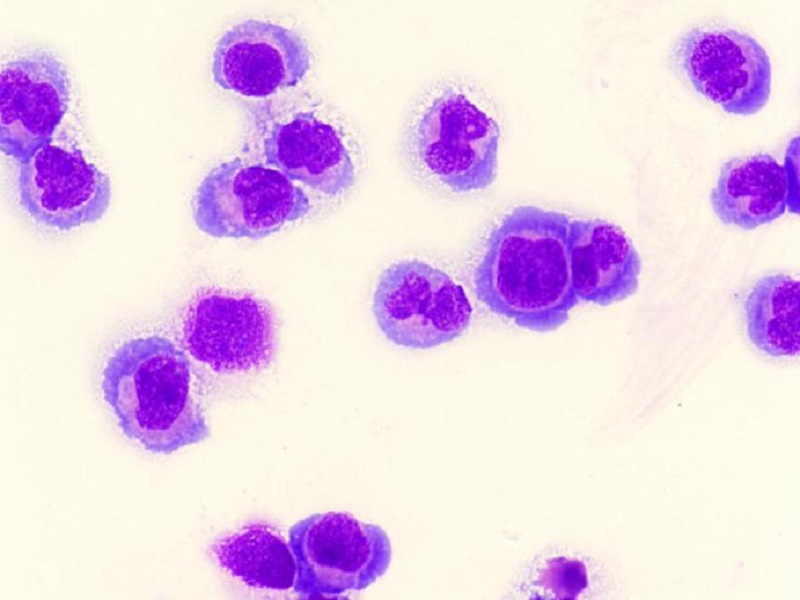Leucemia mieloide acuta