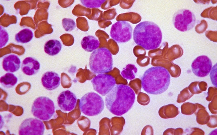 Leucemia mieloide cronica: rimborsato anche in Italia asciminib, capostipite di una nuova generazione di farmaci, i cosiddetti STAMP inibitori