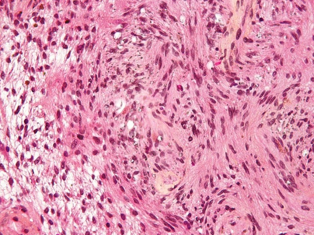 Neurofibromatosi: parere europeo positivo per selumetinib, prima terapia per i bambini con la forma di tipo 1