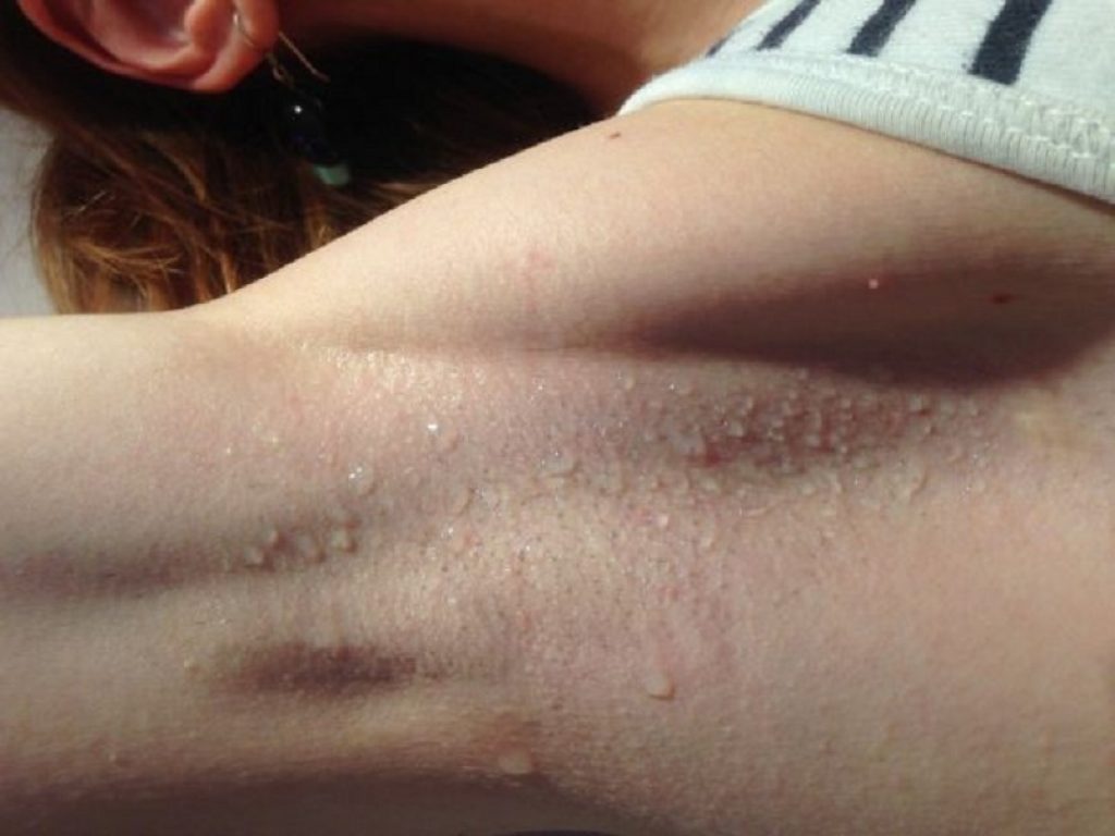 Nei pazienti con iperidrosi ascellare l'applicazione una volta al giorno di un gel a base di bromuro di sofpironio ha ridotto la gravità del disturbo