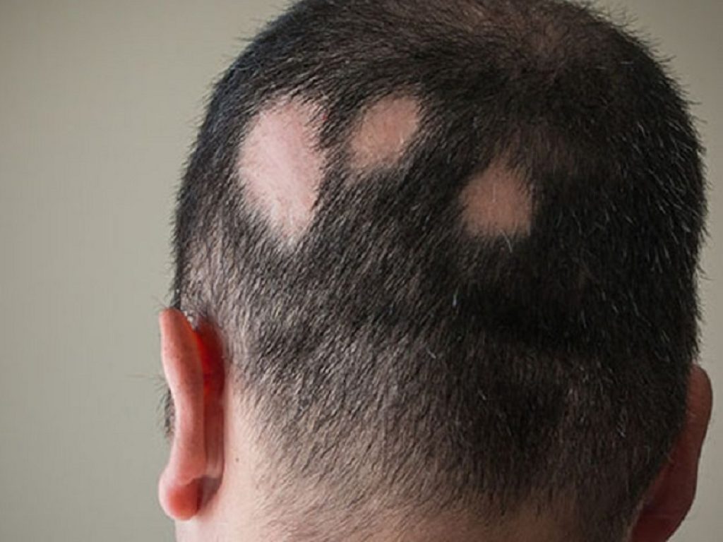 Alopecia areata, una forma modificata del Jak inibitore ruxolitinib passa in fase III: ha mantenuto performance elevate di efficacia e tollerabilità