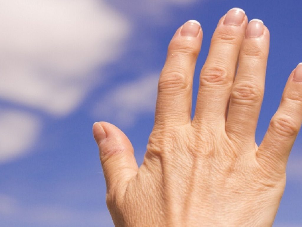 Artrosi della mano, colchicina fallisce nel lenire il dolore
