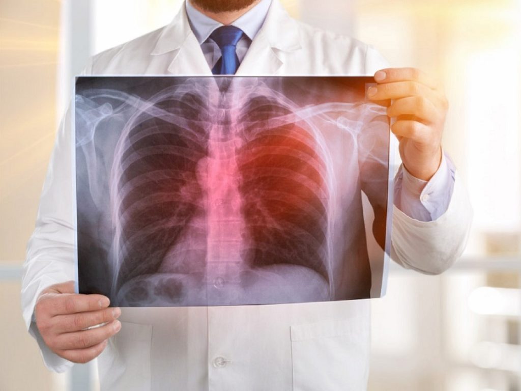 Discinesia ciliare primaria, azitromicina ben tollerata e dimezza il tasso di riacutizzazioni respiratorie secondo uno studio di fase 3