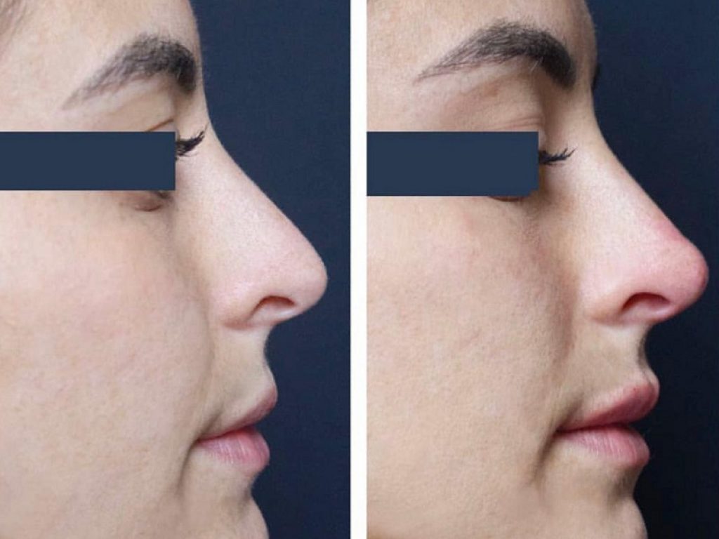 Il rinofiller è delle più recenti tendenze della medicina estetica: con le micro iniezioni di sostanze riassorbibili si può eliminare la “gobbetta”, ottenere un naso più bello e correggere piccole imperfezioni