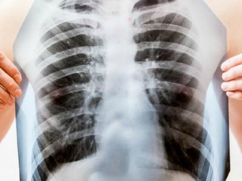 Nei pazienti con carcinoma polmonare non a piccole cellule portatori di mutazioni del gene EGFR, la combinazione osimertinib-chemioterapia allontana la progressione