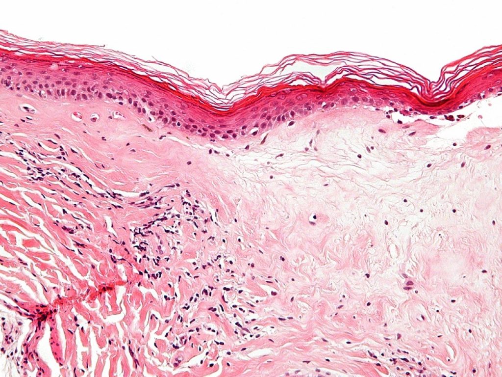 Lichen scleroatrofico, arriva un libro per spiegare ai bambini la vita con la malattia: è intitolato “Le domande di Emma”