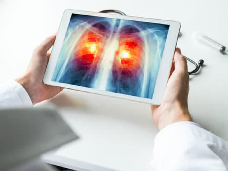 Rischio ipercapnia più elevato nei pazienti con Bpco che hanno una funzione polmonare peggiore e una storia pregressa di insufficienza respiratoria ipercapnica acidotica