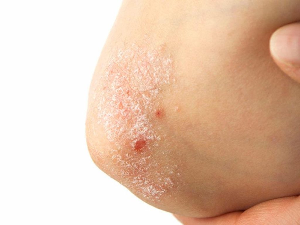 Fanno parte dell’Alleanza Psoriasi le società scientifiche SIDeMaST e ADOI e il laboratorio italiano per l’analisi, l’innovazione e il cambiamento SALUTEQUITÀ