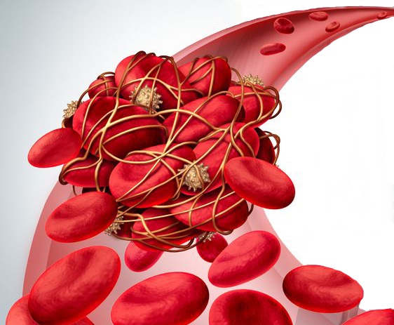 Tromboembolismo venoso: conferme di efficacia per milvexian secondo i risultati dello studio di fase 2 AXIOMATIC-TKR